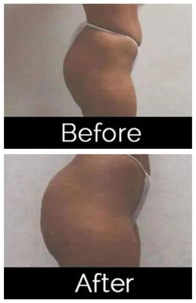 Before and after image of a butt lift performed by Dr. Friedlander in Atlanta Georgia.