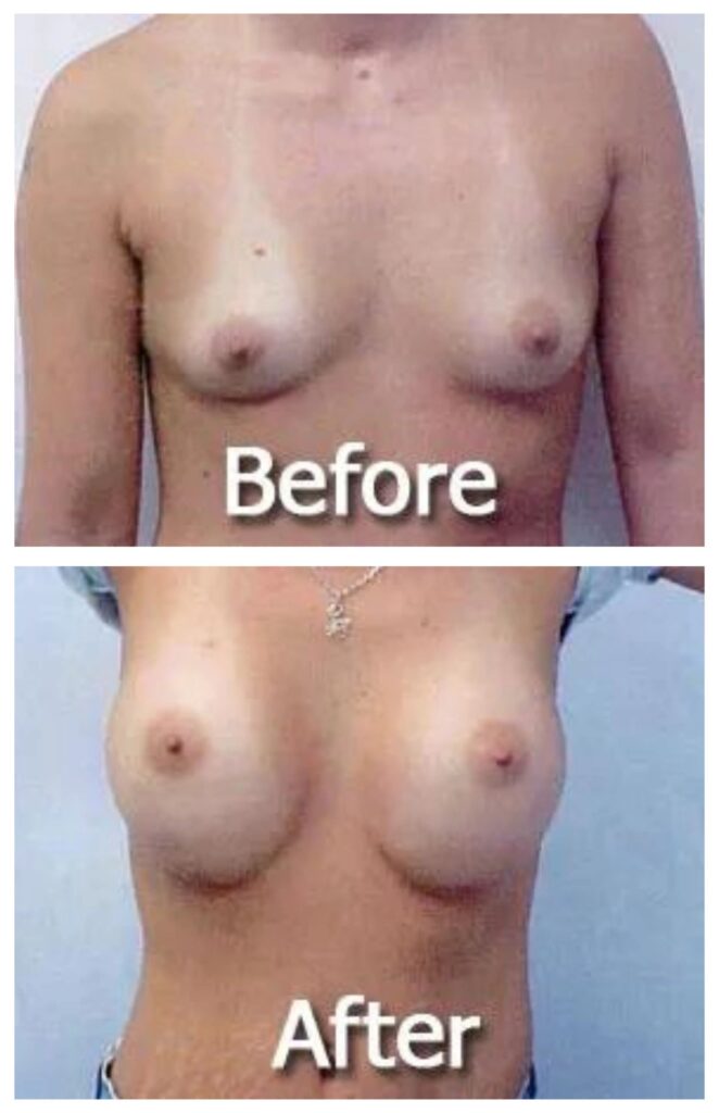 Breast augmentation before and after image performed by Dr. Friedlander in Atlanta Georgia.