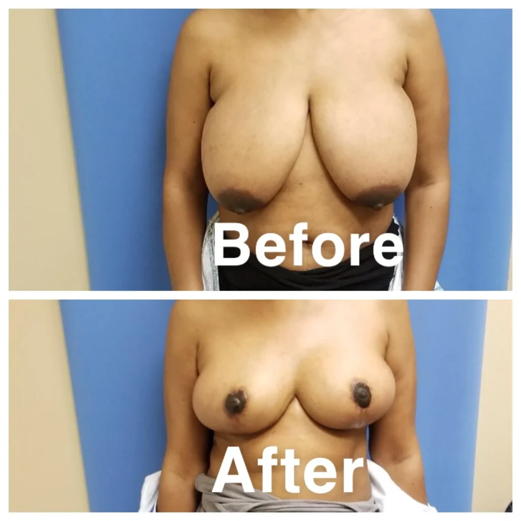 women before and after of breast reduction