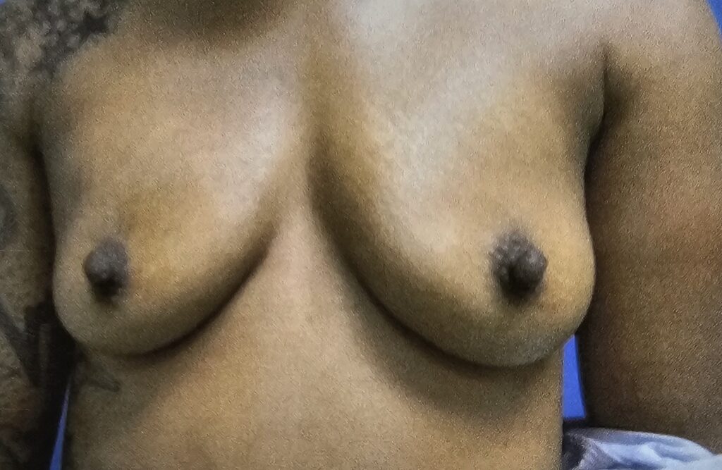 A woman before her Breast augmentation surgery