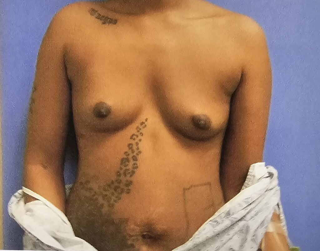A woman before her Breast augmentation surgery