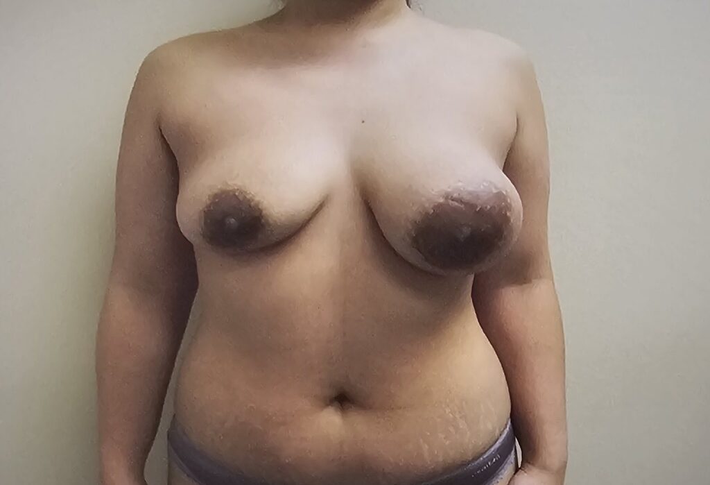 Breast augmentation in atlanta before and after