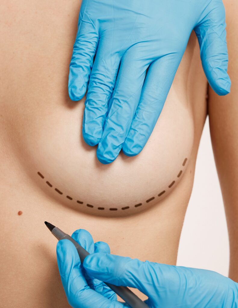 Gloved hands marking a breast for surgery preparation.