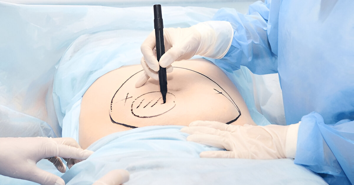 Tummy Tuck Scar Treatment | A Complete Guide