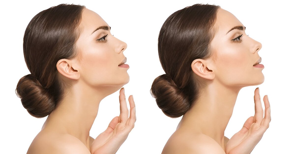 How Much Does Neck Lift Surgery Cost – 2025 Guide