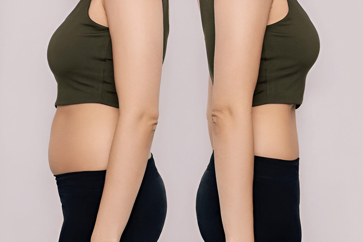 How to Choose the Best Liposuction Surgeon: A Patient’s Guide to Safe & Satisfying Results