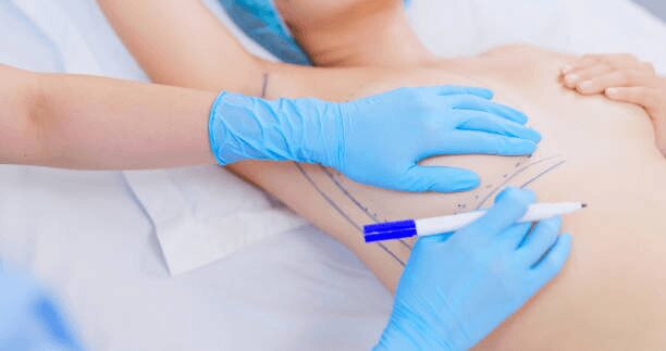 Breast Augmentation Options in Atlanta, GA: Implants vs Natural Fat Transfer
