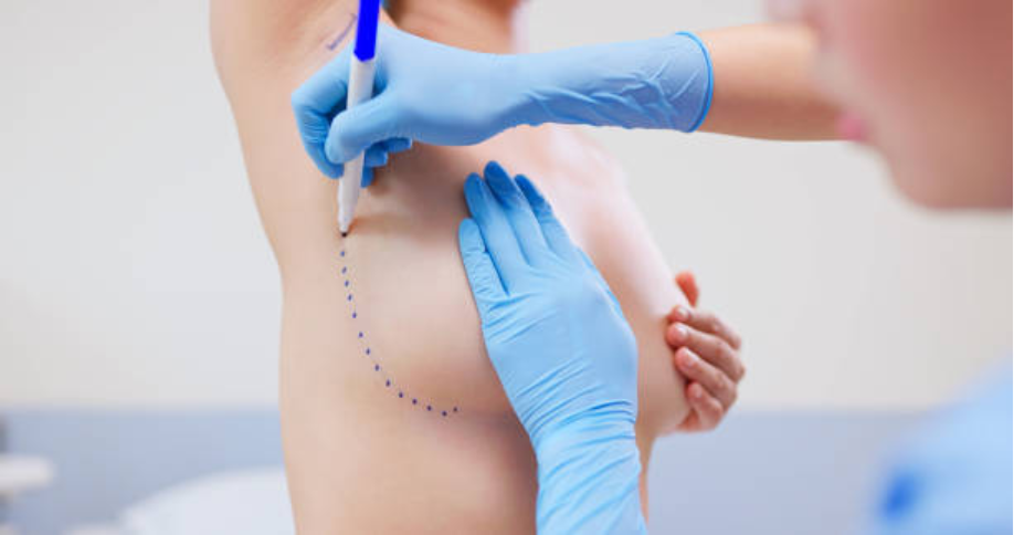 Fat Transfer Breast Augmentation in Atlanta, GA: A Natural Approach Without Implants 